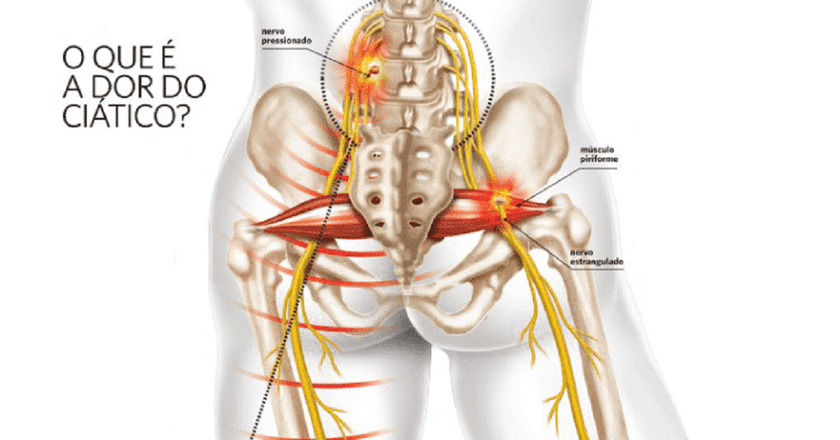 Dor No Nervo Ciático O Que é Sintomas E Tratamento Do Problema 