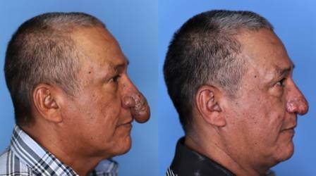 Conrado Estrada antes e depois da cirurgia plstica