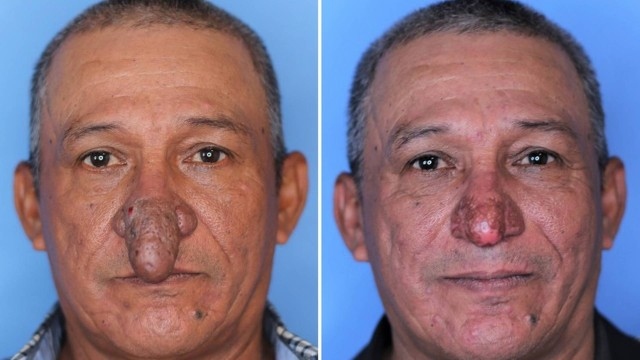 Conrado Estrada antes e depois da cirurgia