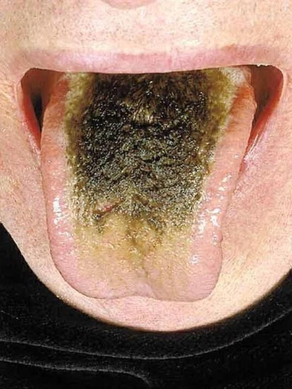 Em 2006 publicao acadmica publicou caso de fumante que viveu com doena por vrios anos Foto The New England Journal of Medicine